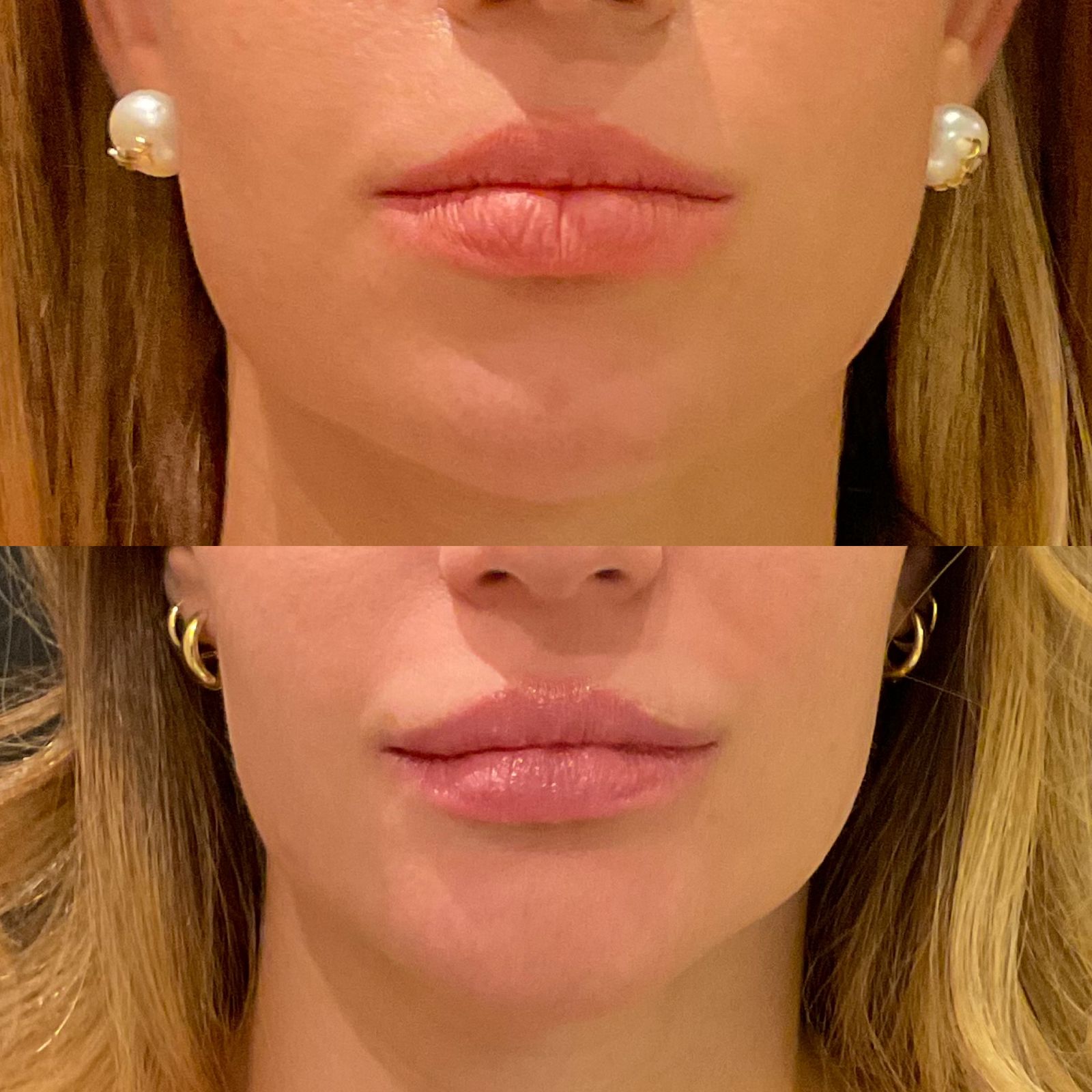 preenchimento-labial-goiania.jpeg